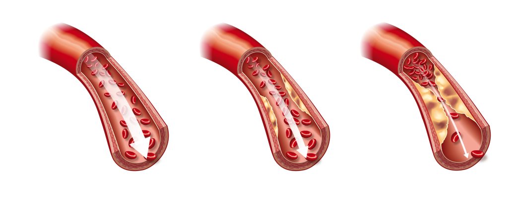 Ilustración que muestra una arteria sana y una arteria arteriosclerótica con placa